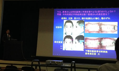 徳大額顔面矯正分野田中栄二教授による外科的矯正治療についての講演会に参加しました。