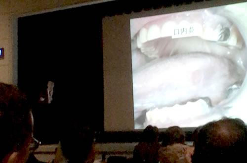 徳島大学大学院教授　宮本洋二先生による、徳島県歯科医師会学術講演会「口腔粘膜疾患・口腔がんの診察方法と薬剤関連性顎骨壊死（MRONJ）」に出席しました。